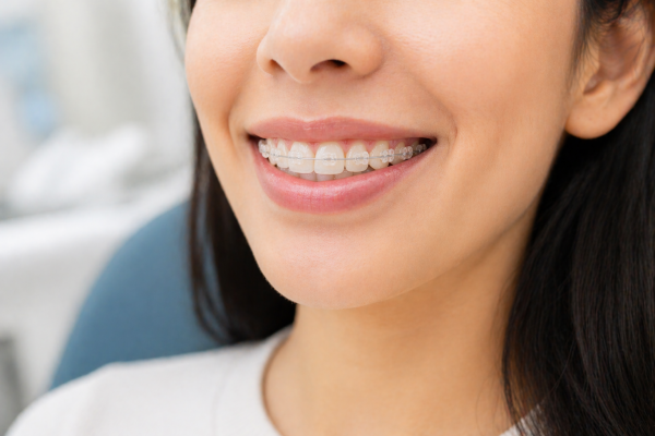 Ceramic Braces