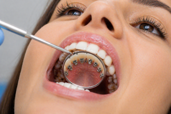 Lingual Braces