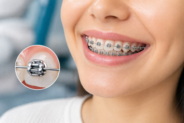 Self-Ligating Braces